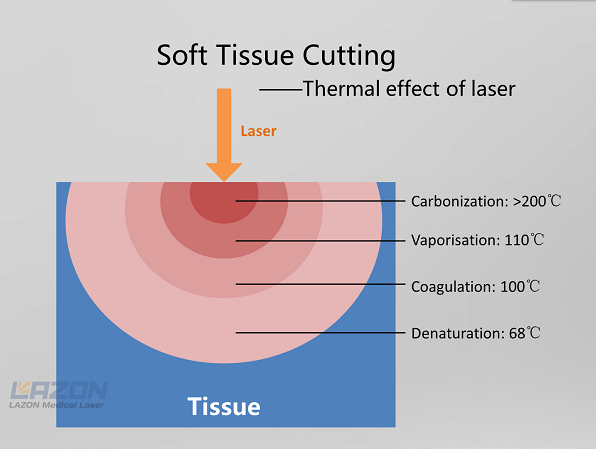 Laser Soft tissue cutting