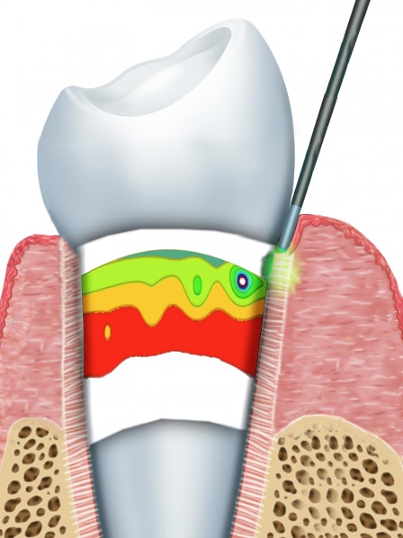 Lasers in Periodontics